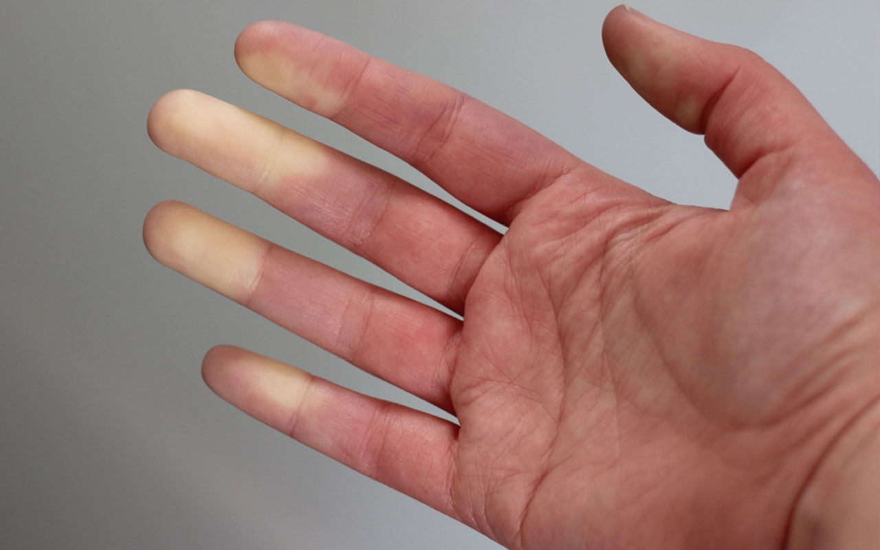Φαινόμενο Raynaud